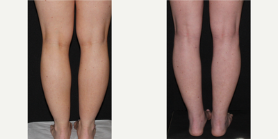25-34 year old woman treated with Calf Reduction - 27 year old before and six weeks after liposuction to thighs, inner knees, calves and ankles.