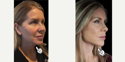 Woman treated with Neck Lift, Facelift - Who says neck and jawline tightening is out of reach?Most women believe transformations like this one are difficult, or even impossible, for them to achieve.We offer rejuvenations that are both completely natural and highly effective.