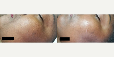 Woman treated with Dermaplaning - Woman treated with Dermaplaning