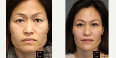 Fraxel Laser - Eyelid surgery with filler and laser treatments.
