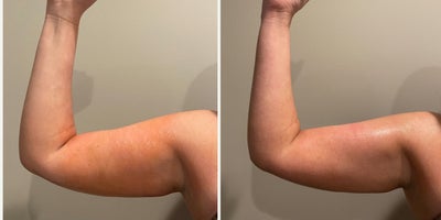 25-34 year old woman treated with Body Wrap - Before and immediately after one Bioslimming Body Wrap at Wise Med Spa