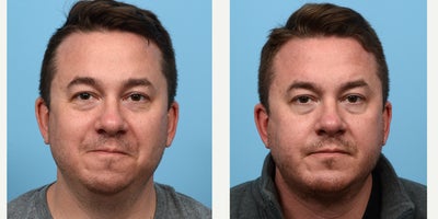 35-44 year old man treated with Chin Surgery - chin implant and submental liposuction