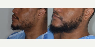 25-34 year old man treated with FUE Hair Transplant - 30 year old male patient desiring a fuller beard.  Before and after 2,000 FUE graft to the beard.