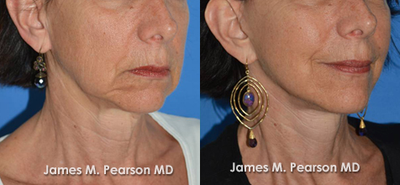55-64 year old woman treated with Facelift - Patient underwent a Facelift with Dr. Pearson