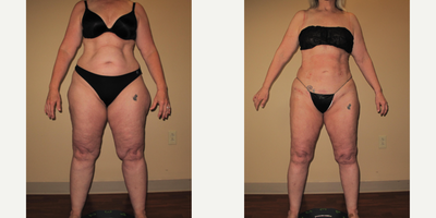 45-54 year old woman treated with Lipedema Surgery - Lipedema patient who had multiple surgeries that included her thighs, hips, buttocks, calves and abdomen and flanks.