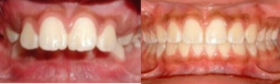17 or under year old man treated with DNA Appliance - Neuromuscular Jaw Orthopedic with oral appliance therapy to improve TMJ , Airway and posture.