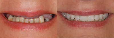 This female patiented with hopeless and missing teeth. All teeth in the top jaw were replaced with implant bridge.   - 
	This patient presented with missing and hopeless teeth in the top jaw. In the bottom jaw patient had missing and hopeless back teeth. All teeth in the top jaw were replaced with an implant supported bridge. In the bottom jaw back teeth were replaed with implant supported bridges.
