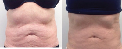 45-54 year old woman treated with Vanquish - 3 sessions