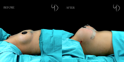 25-34 year old woman treated with Breast Implants, Breast Lift - 25-34 year old woman treated with Breast Implants, Breast Lift