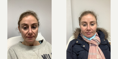 35-44 year old woman treated with Teosyal - Dermal fillers to NL
