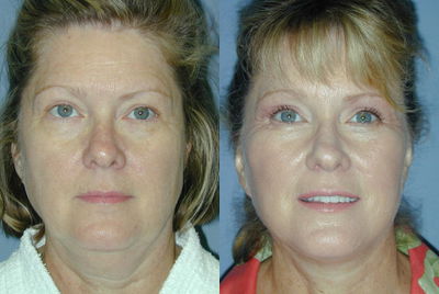 Face Lift on 57-year-old Woman - This 57-year-old woman had a face lift.&nbsp;