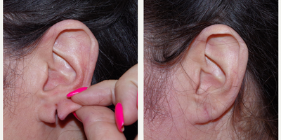 45-54 year old woman treated with Ear Lobe Surgery - 50 year old female received an ear lobe repair; photos depict the patient's results 1 month post-op.