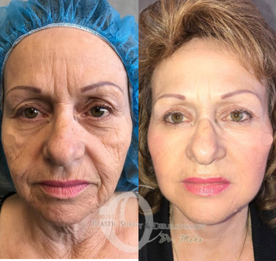 Woman treated with Laser Treatment - Woman treated with Laser Treatment, shown 2 weeks post op. Patient also had deep chemical skin treatment (chemical peel) as well as Mehr design full facelift, extended neck lift, and upper eyelid surgery.