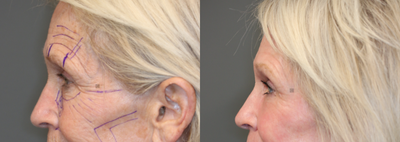 CO2 Laser and Stem Cell Fat Transfer - Laser resurfacing with fractionated CO2 and stem cell fat transfer.