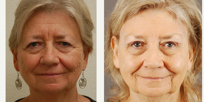 65-74 year old woman treated with Brow Lift - Brow lift and upper eyelid blepharoplasty performed by Dr. Bryson Richards.