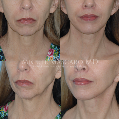 55-64 year old woman treated with Facelift - Patient had a face and necklift, chin implant, SMAS graft to the upper and lower lips as well as a lip lift