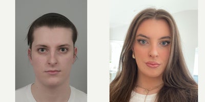 18-24 year old woman treated with Asian Rhinoplasty, Facial Fat Transfer, Nonsurgical Facelift, Rhinoplasty, V Line Surgery - .