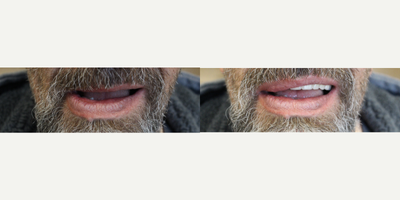 55-64 year old man treated with Mini Dental Implants - 55-64 year old man treated with Mini Dental Implants