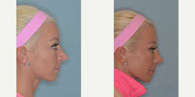 25-34 year old woman treated with Revision Rhinoplasty - Patient's concerns included a pinched and pointy tip and an over-projected nose after rhinoplasty. Revision rhinoplasty techniques included tip setback with caudal extension graft and lateral crural strut grafts. Middle vault correction with bilateral spreader grafts and temporalis fascia graft.