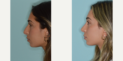 Woman treated with Rhinoplasty - Woman treated with Rhinoplasty