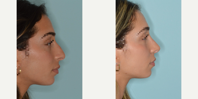 Woman treated with Rhinoplasty - Woman treated with Rhinoplasty