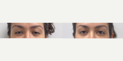 25-34 year old woman treated with Upneeq - Upneeq Treatment done on eyes