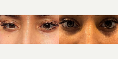 25-34 year old woman treated with Upneeq - Upneeq Treatment done on eyes