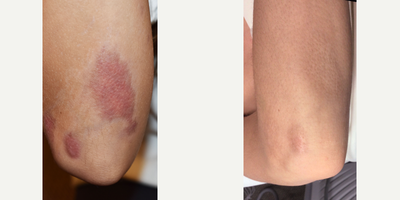 Laser Scar Removal with VBeam for red scars. - Scars can sometimes make us feel self-conscious. If you've had an accident or surgery and want to talk about scar revision/removal, give us a call today. #celibre #scarremoval #laserforscars #scarrevision #vbeamlaser