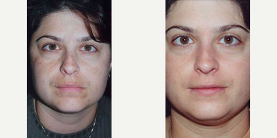 MegaPeel Microdermabrasion - MegaPeel Microdermabrasion