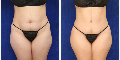 Woman treated with Tummy Tuck - Woman treated with Tummy Tuck