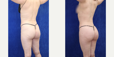 Woman treated with Brazilian Butt Lift - Woman treated with Brazilian Butt Lift