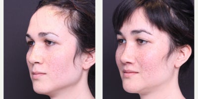 25-34 year old transgender woman treated with Facial Feminization Surgery, Adam's Apple Reduction - Thyroplasty, AFG to Face, Browbone Reduction, Browlift, Hairline Advancement, Rhinoplasty, Liplift, Mandible/Chin Contouring, Sliding Genioplasty, Submental Liposuction