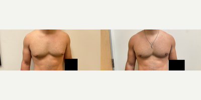 Man treated with Gynecomastia Surgery - Man treated with Gynecomastia Surgery