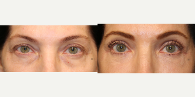 Enigmalift Upper and Lower Eyelid Surgery - Enigmalift upper and lower eyelid surgery with laser resurfacing and fat transfer.