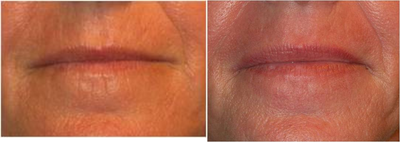Active & Deep FX ~ CO2 Laser Skin Resurfacing - Before &amp; After PhotosMax FX CO2 Laser Resurfacing of the mouth and perioral lines around the lips
