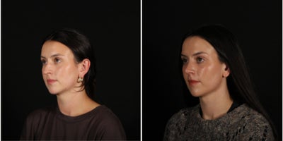 25-34 year old woman treated with Rhinoplasty, Neck Lift, Buccal Fat Removal - 6 weeks after rhinoplasty, deep neck lift, renuvion skin tightening, and buccal fat removal! Our patient has been healing beautifully and we are loving the (early) result! Thanks to her for allowing us to share. Combing procedures is hugely helpful to achieving a more profound, intricate, but natural result. Here we refined the neck and the nose concurrently.