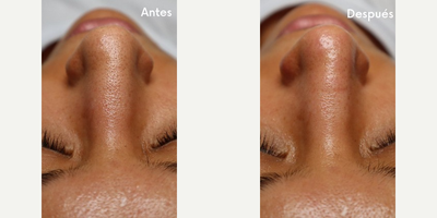 Woman treated with HydraFacial - Hydrafacial is the perfect solution for a complete cleanse of your skin.