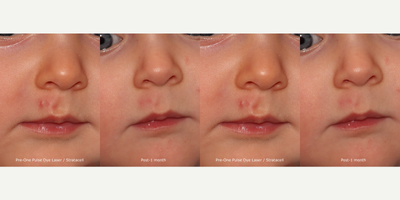17 or under year old woman treated with Pulsed Dye Laser - Dr. Goldman used Pulse Dye Laser to treat this 6 month's old Impetigo.