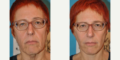 Woman treated with Lower Facelift - Woman treated with Lower Facelift and Neck Lift. Pre-op, patient disliked the sagging skin on her lower face, cheeks, nasolabial folds, jowls, and her neck laxity.