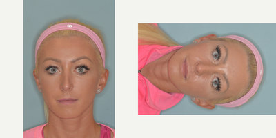 25-34 year old woman treated with Revision Rhinoplasty - Patient's concerns included a pinched and pointy tip and an over-projected nose after rhinoplasty. Revision rhinoplasty techniques included tip setback with caudal extension graft and lateral crural strut grafts. Middle vault correction with bilateral spreader grafts and temporalis fascia graft.