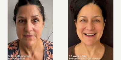 45-54 year old woman treated with Morpheus8, HydraFacial - Before and 12 weeks after customized treatment plan combining Morpheus8 RF microneedling and HydraFacial treatments. Skin appears firmer, smoother, and lifted. Overall texture and facial vitality improved.