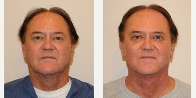 55-64 year old man treated with Chemical Peel - This gentleman was treated with a customized chemical peel, including TCA and Jessners. He also had a lower face and neck lift as well as an upper eyelid blepharoplasty.