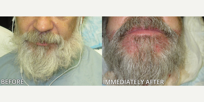 Man treated with Beard Transplant - Man treated with Beard Transplant