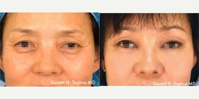 45-54 year old woman treated with Endoscopic Brow Lift & Lower Blepharoplasty - 45-54 year old Asian woman s/p Endoscopic Brow Lift, Lower Blepharoplasty with lateral canthopexy