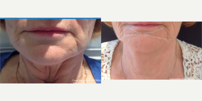 Silhouette Soft Neck Treatment - Neck Treatment using Silhouette Soft