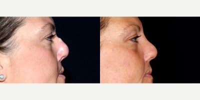 43 year old woman treated with Cleft Lip And Cleft Lip Revision. - 43 year old woman treated with Cleft Lip And Cleft Lip Revision. Photos depict before and 9 months after surgery.