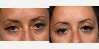 25-34 year old woman treated with Vollure - under-eye