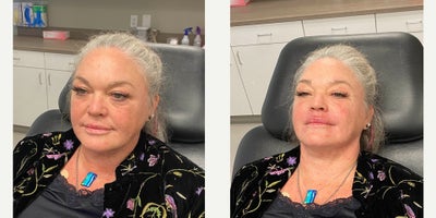 55-64 year old woman treated with Nonsurgical Facelift - Liquid facelift with dermal fillers and botox.