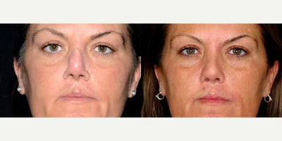 43 year old woman treated with Cleft Lip And Cleft Lip Revision. - 43 year old woman treated with Cleft Lip And Cleft Lip Revision. Photos depict before and 9 months after surgery.