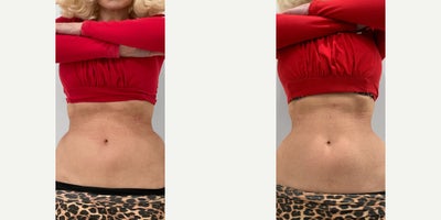 45-54 year old woman treated with truSculpt flex - Patient wanted to snatch her waist and get that smooth curve from her waist to her hips.